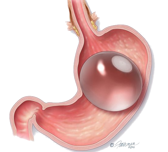 intragastric balloon